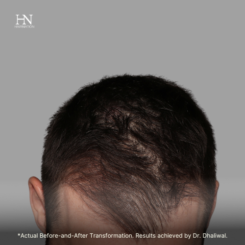  Pre & Post FUE June (3) - Before/After 