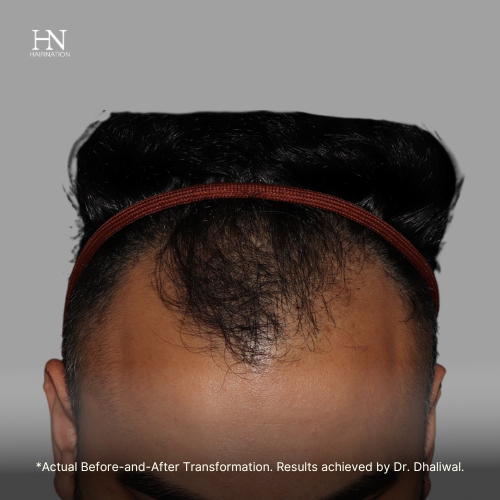 6 months  post FUE - Before/After