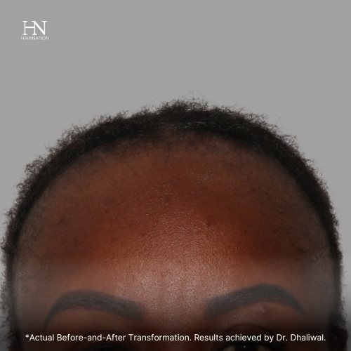 Hairline - Before/After  