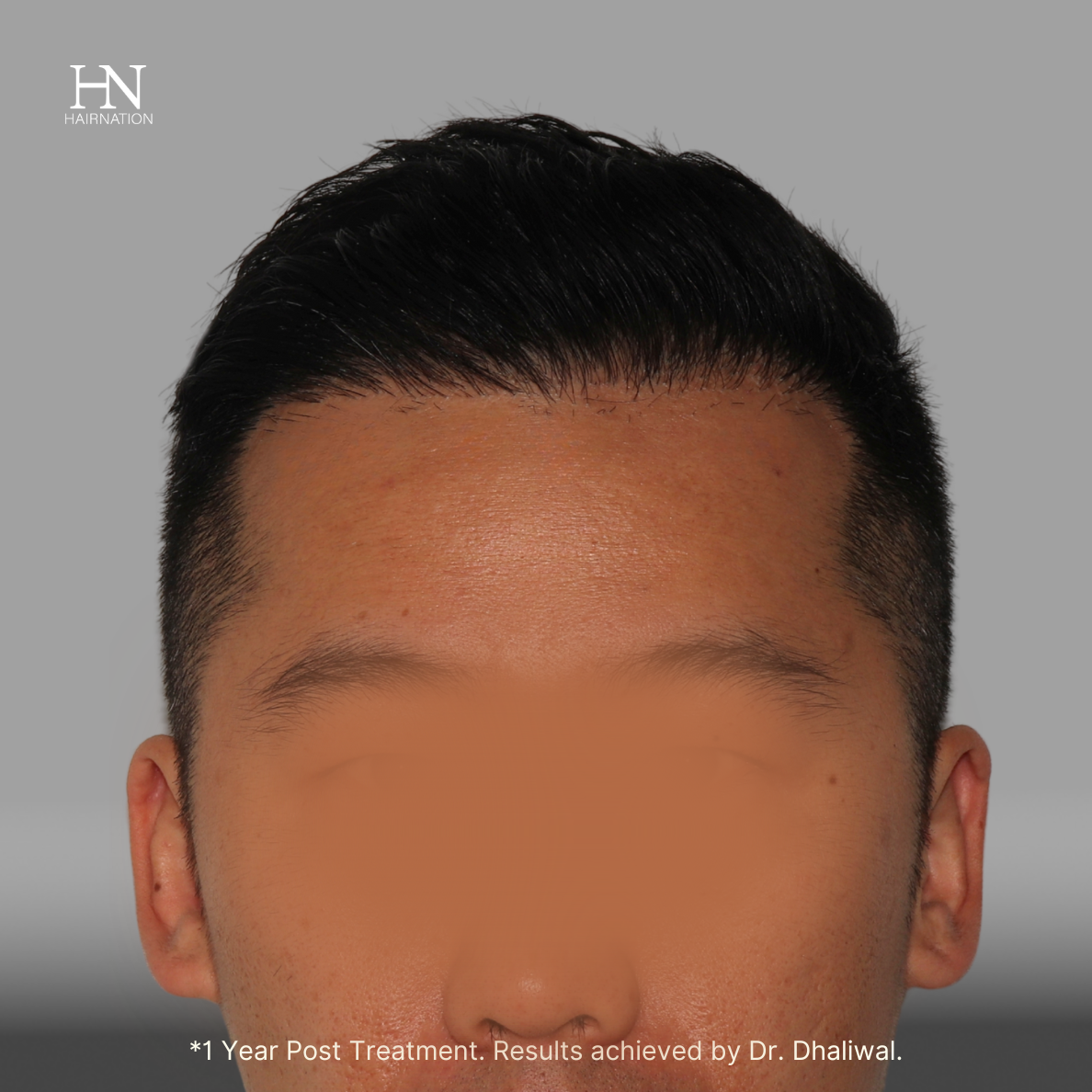 1 year post FUE - Before/After