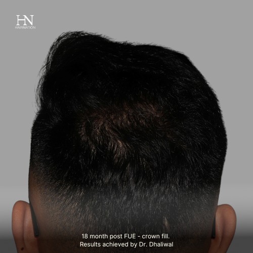 1 year post FUE Crown Fill - Before/After