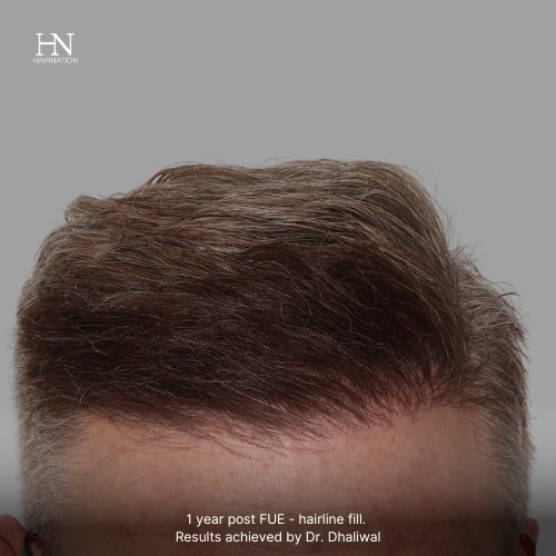 1 year post FUE Hairline Fill - Before/After