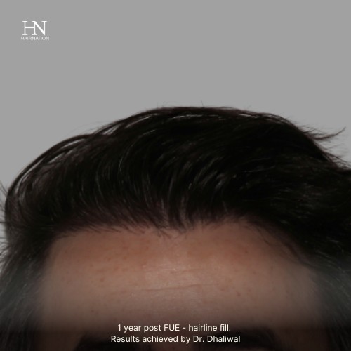 1 year post FUE Hairline Fill - Before/After