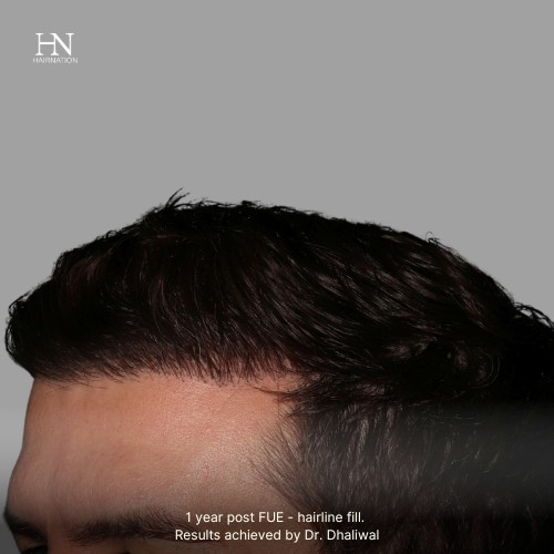 1 year post FUE Hairline Fill - Before/After