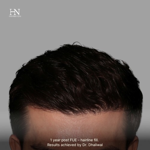 Pre/Post-FUE Hairline Transformation - 5