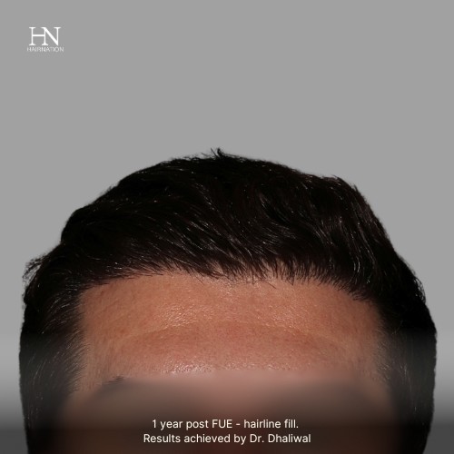 Pre/Post-FUE Hairline Transformation - 6