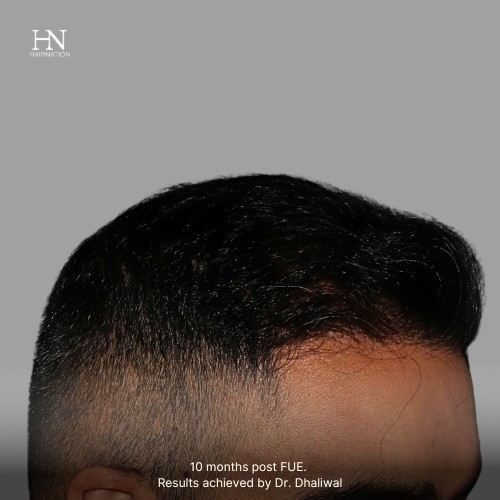 Pre/Post-FUE Hairline Transformation - 7