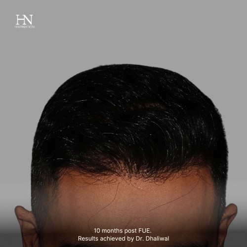 Pre/Post-FUE Hairline Transformation - 8