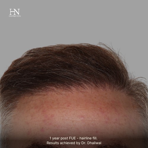 1 year post FUE Fill - Before/After
