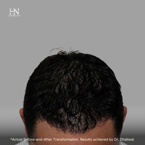  Pre & Post FUE 1 Year - Before/After 