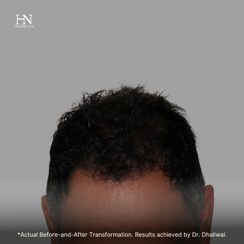  Pre & Post FUE June 1 - Before/After 