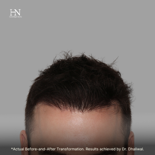  Pre & Post FUE June (1) - Before/After  