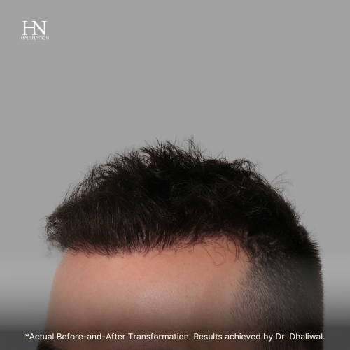  Pre & Post FUE June (2) - Before/After  