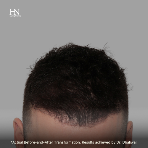  Pre & Post FUE June (3) - Before/After 