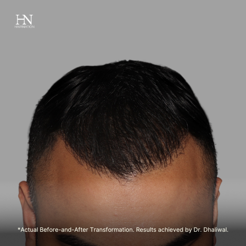 6 months  post FUE - Before/After