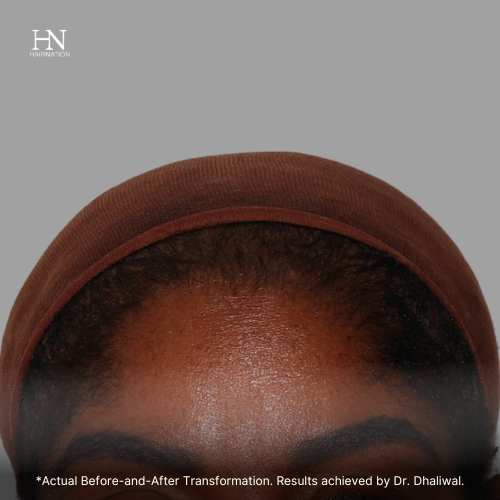 Hairline - Before/After  
