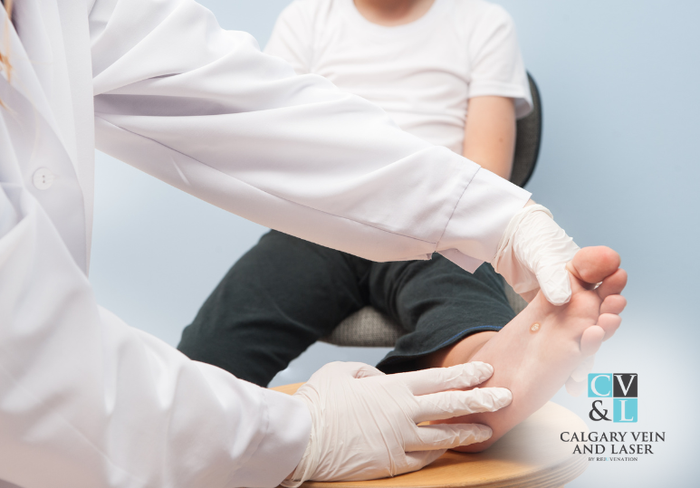 Risks and Side Effects of Wart Removal Treatments
