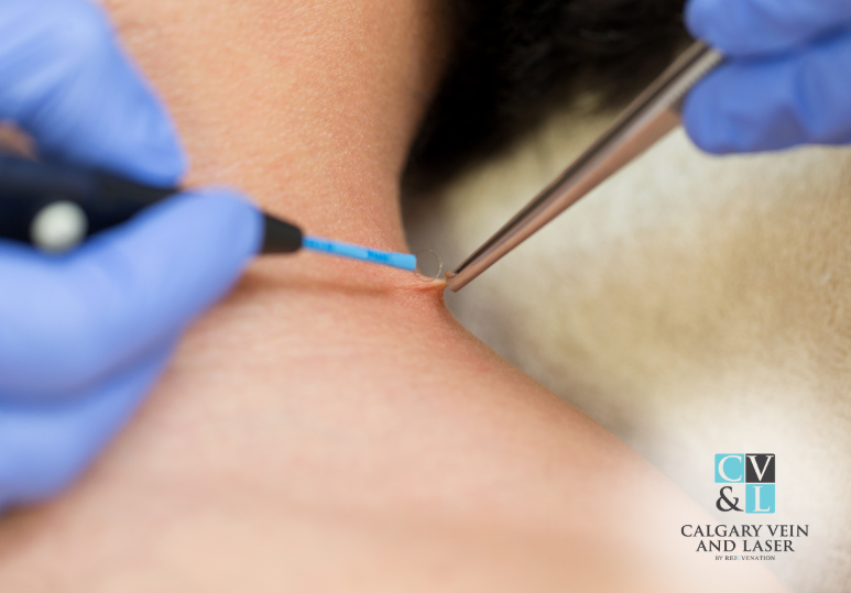 Is Wart Removal Painful?