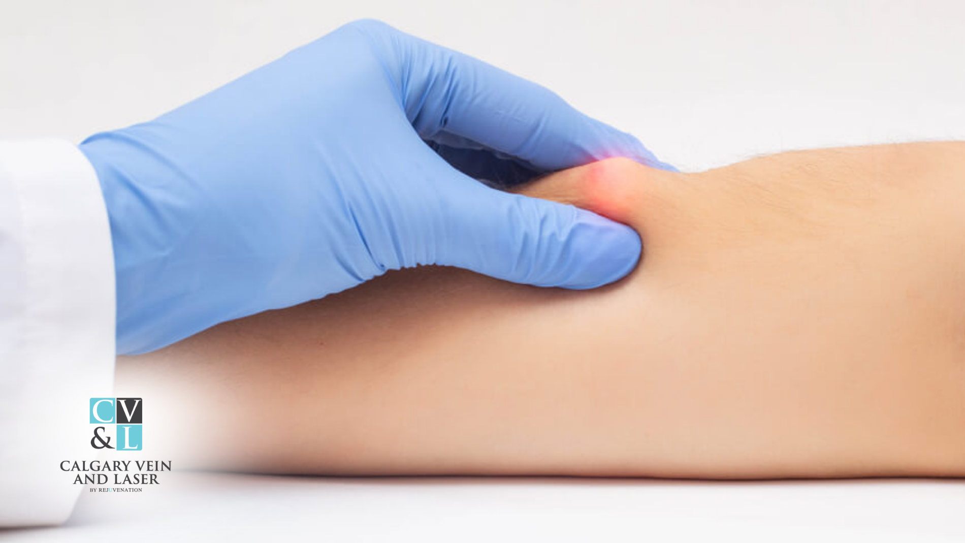 Epidermoid vs. Sebaceous Cysts: What’s the Difference?