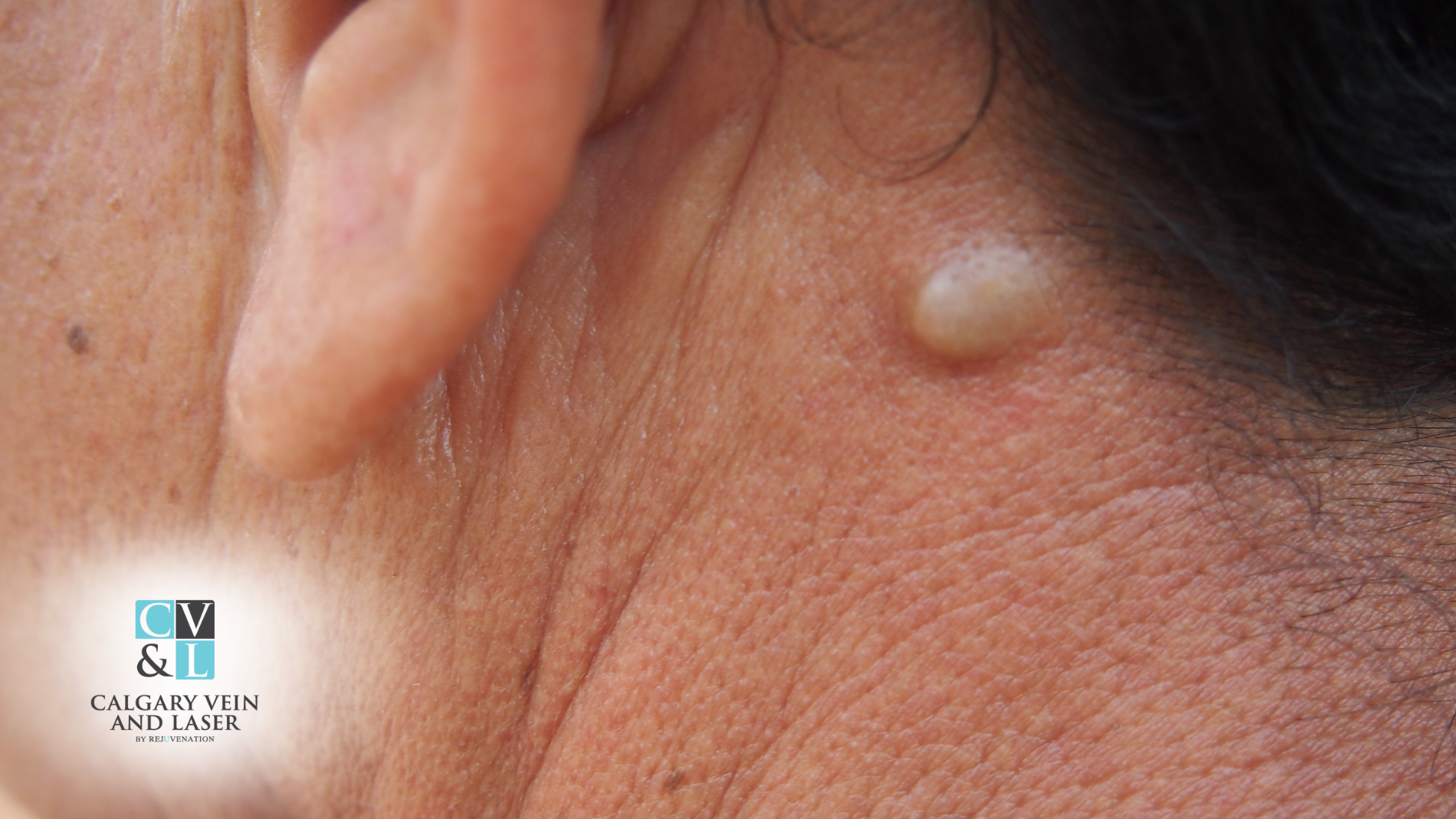 Can You Prevent Epidermoid Cysts? Myths vs. Facts