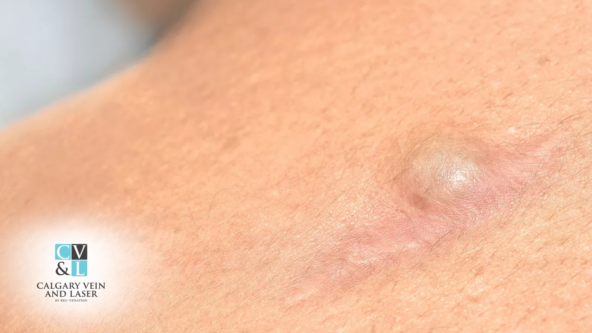 What Is an Epidermoid Cyst? Understanding This Common Skin Lump
