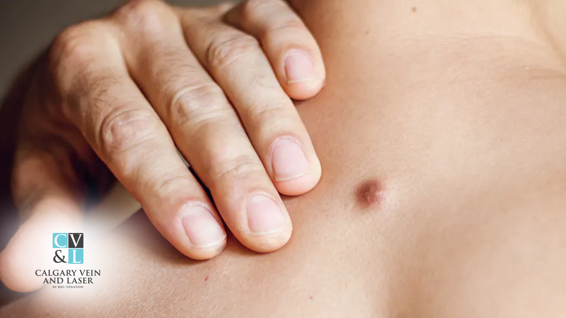 The Dangers of Popping Cysts at Home (and What to Do Instead)