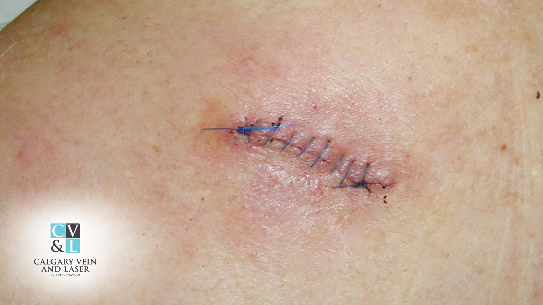How Should You Care for Your Skin After Cyst Excision?