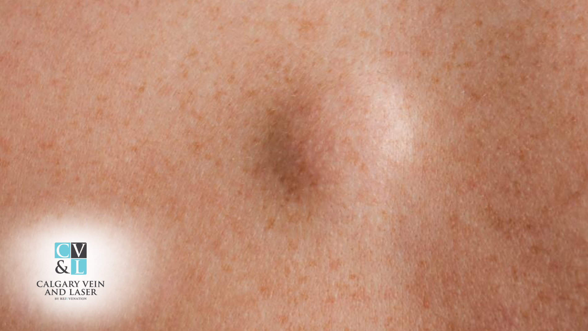 What Is a Lipoma? Understanding Benign Fatty Tumors