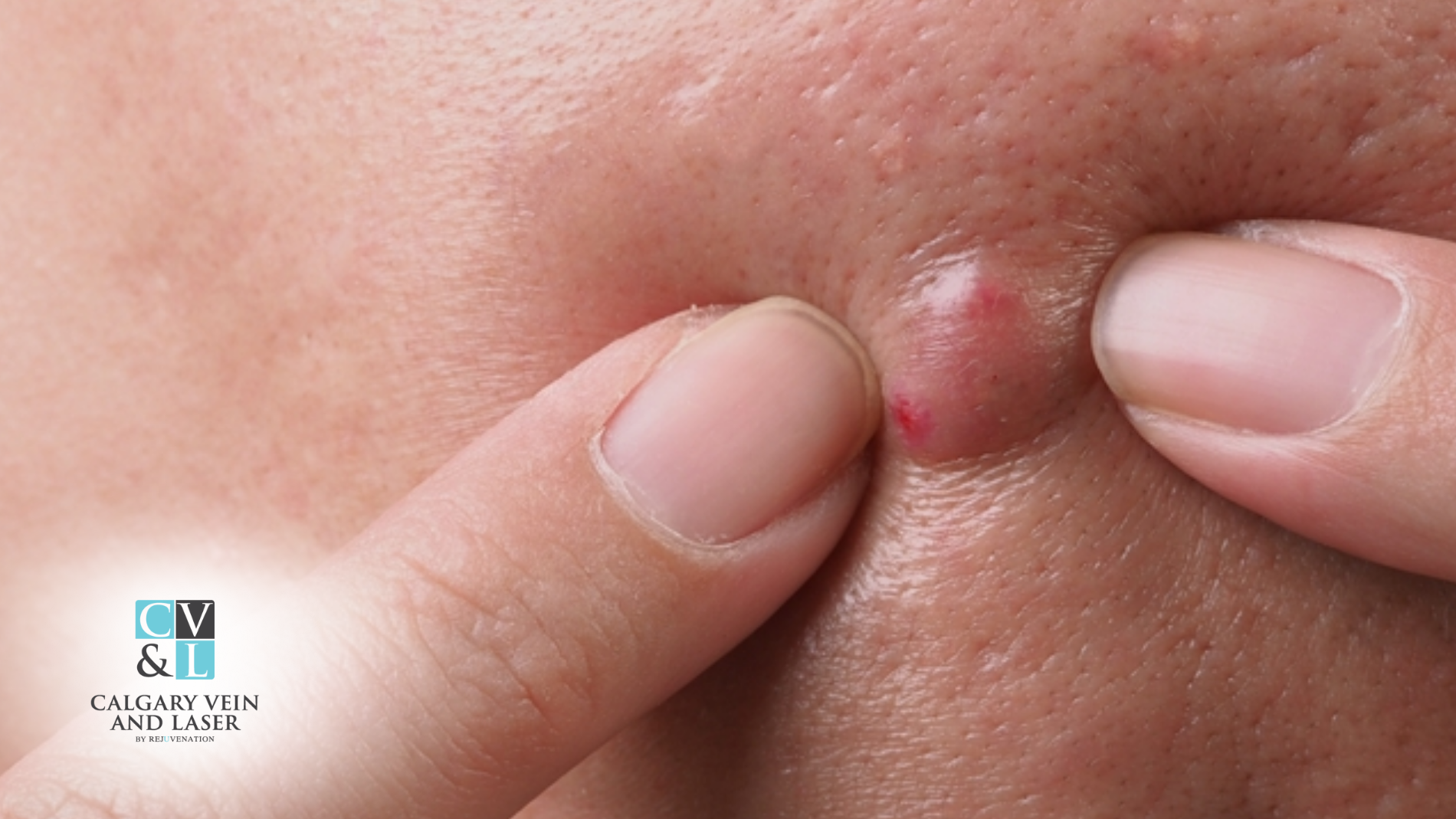 When a ‘Pimple’ Isn’t a Pimple: Spotting Hidden Cysts