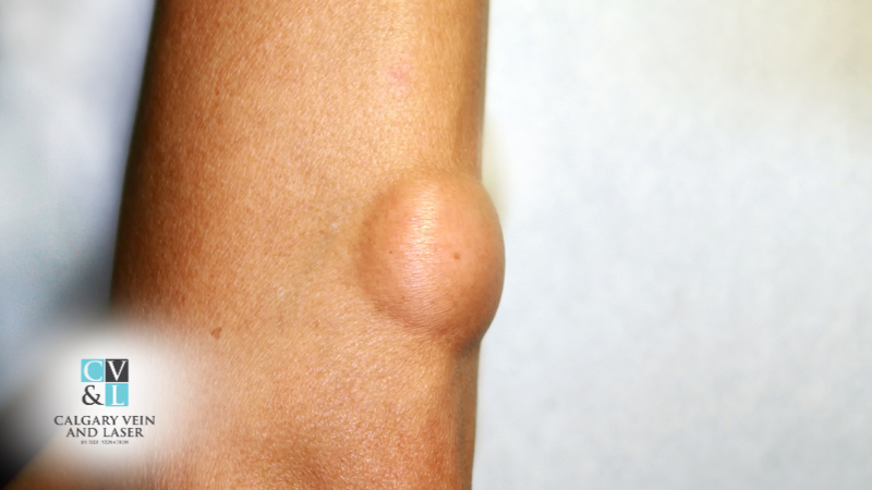 Are Lipomas Dangerous? When to Worry About a Lump