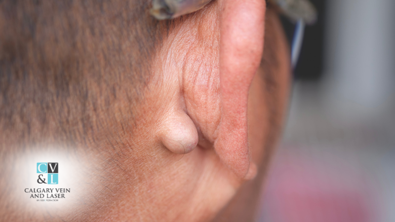 Why Do Lipomas Form? Causes, Genetics, and Risk Factors