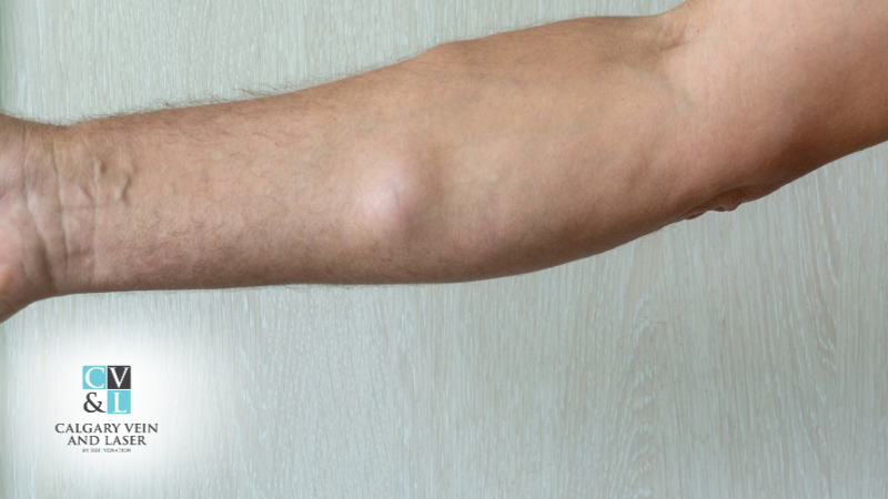 Do Lipomas Ever Go Away on Their Own? What to Know