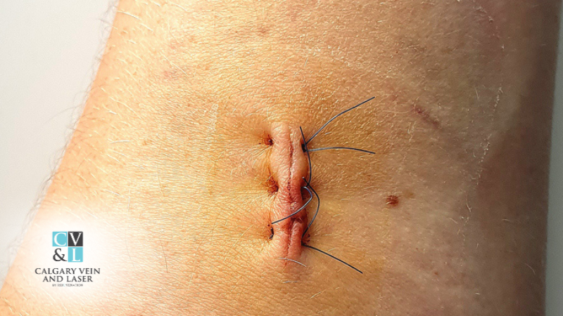 Lipoma Removal: What to Expect During and After Surgery