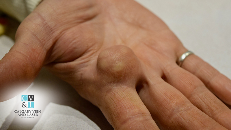 The Cost of Lipoma Removal: Is It Worth It?