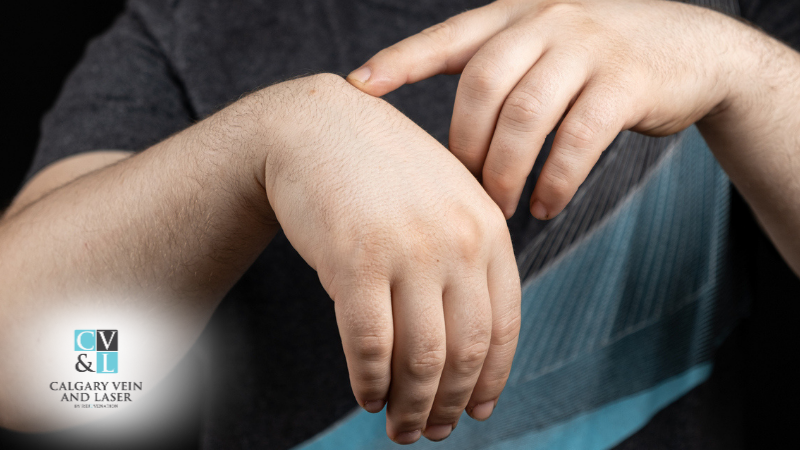  Do Diet and Exercise Affect Lipomas? What the Science Says?