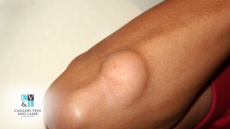 Post-Removal Care: How to Prevent Scars and Recurrence