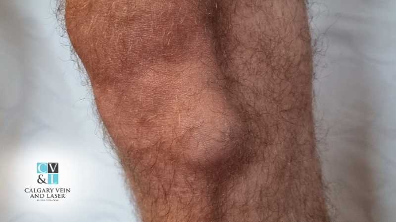 How to Tell a Lipoma Apart from a Fat Deposit