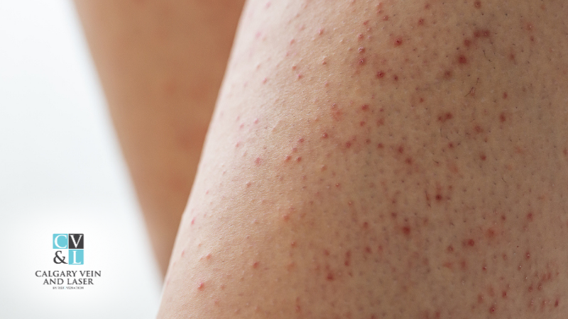 Tiny Bumps on Your Arms or Face? It Might Be Keratosis Pilaris — Here’s How to Treat It