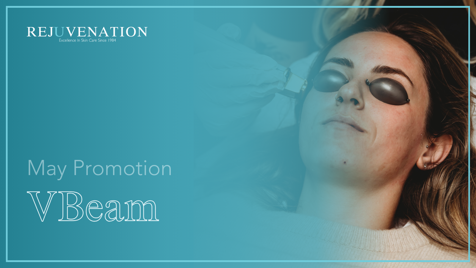 VBeam® Feature — Buy 3, Get 1 FREE