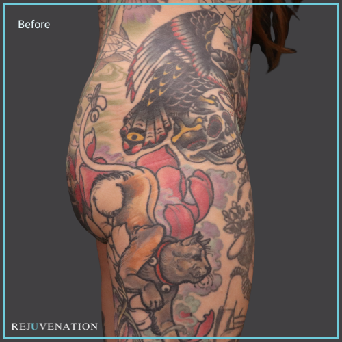 Side Right View Liquid Butt Lift Rejuvenation Medical Aesthetics