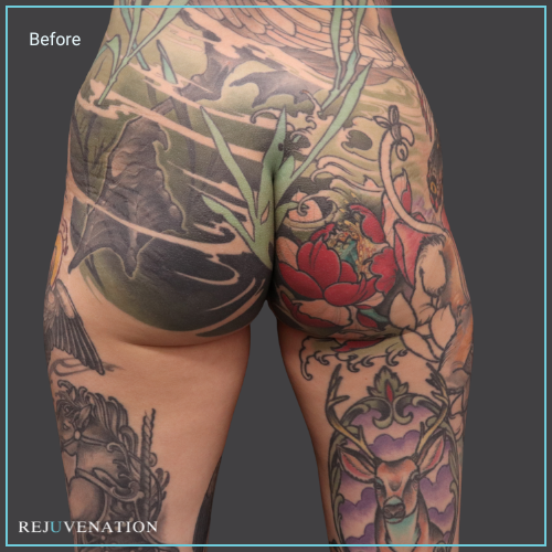 Back View Liquid Butt Lift Rejuvenation Medical Aesthetics