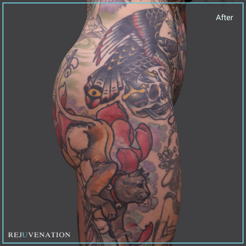 Side Right View Liquid Butt Lift Rejuvenation Medical Aesthetics