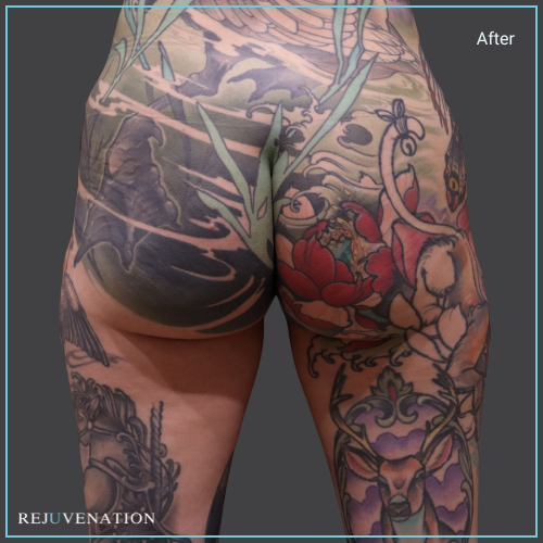 Back View Liquid Butt Lift Rejuvenation Medical Aesthetics